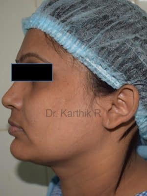 Thread Lift