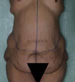 Circumferential Body Lift