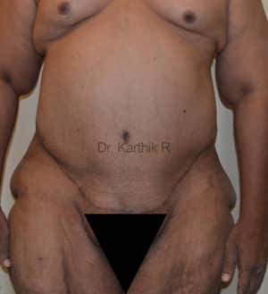 Circumferential Body Lift