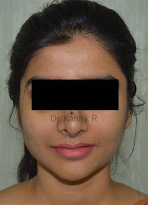 Botox