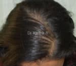 Dermaroller scalp