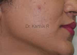 Laser Hair Reduction