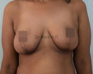 Breast Reduction and Breast Lift