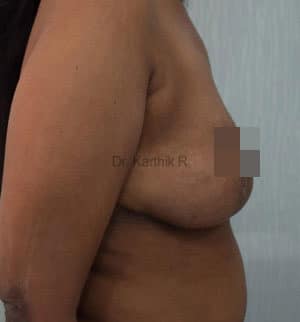 Breast Reduction and Breast Lift