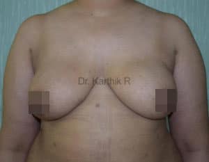 Breast Reduction and Breast Lift