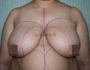 Breast Reduction and Breast Lift