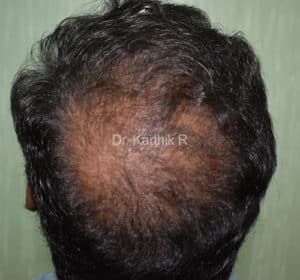 Dermaroller scalp