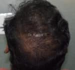 Dermaroller scalp