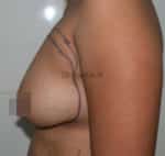 Breast Fat Fill (Breast Augmentation)