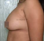 Breast Fat Fill (Breast Augmentation)