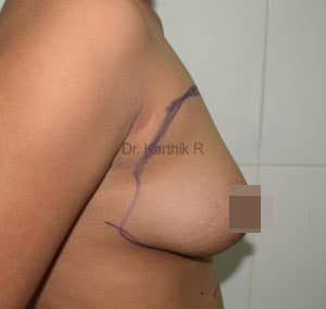 Breast Fat Fill (Breast Augmentation)