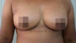 Breast Fat Fill (Breast Augmentation)