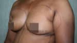 Breast Fat Fill (Breast Augmentation)