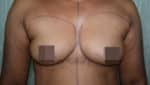 Breast Fat Fill (Breast Augmentation)