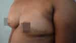 Breast Fat Fill (Breast Augmentation)