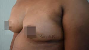 Breast Fat Fill (Breast Augmentation)