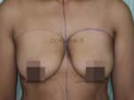 Breast Fat Fill (Breast Augmentation)