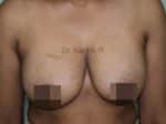 Breast Fat Fill (Breast Augmentation)