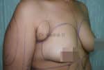 Breast Fat Fill (Breast Augmentation)