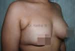 Breast Fat Fill (Breast Augmentation)