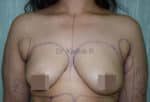 Breast Fat Fill (Breast Augmentation)