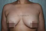 Breast Fat Fill (Breast Augmentation)