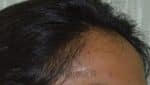 Female Hair Transplant