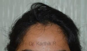 Female Hair Transplant