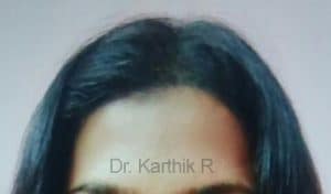 Female Hair Transplant