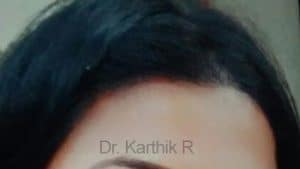 Female Hair Transplant