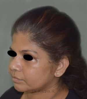 Face lift