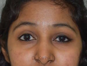 Blepharoplasty