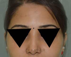 Rhinoplasty (Nose Corrections)