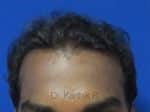 Hair Transplantation