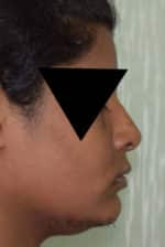 Rhinoplasty (Nose Corrections)