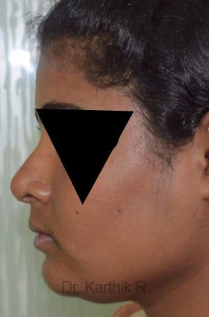 Rhinoplasty (Nose Corrections)