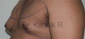 Gynecomastia (Puffy Nipples/ Male Chest Correction)