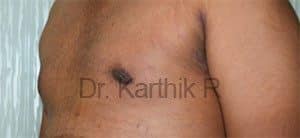 Gynecomastia (Puffy Nipples/ Male Chest Correction)