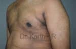 Gynecomastia (Puffy Nipples/ Male Chest Correction)