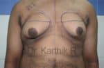 Gynecomastia (Puffy Nipples/ Male Chest Correction)