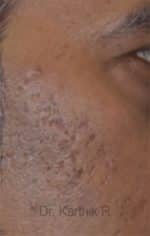 Chemical Peels & Microdermabrasion