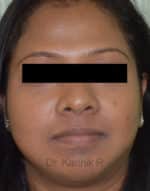 Chemical Peels & Microdermabrasion