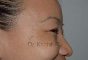 Botox