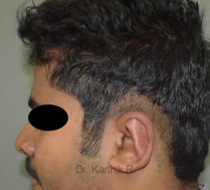 Otoplasty (Ear Correction)
