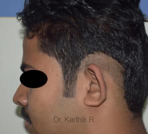 Otoplasty (Ear Correction)
