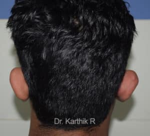 Otoplasty (Ear Correction)