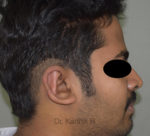 Otoplasty (Ear Correction)