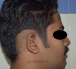 Otoplasty (Ear Correction)