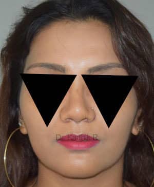 Rhinoplasty (Nose Corrections)