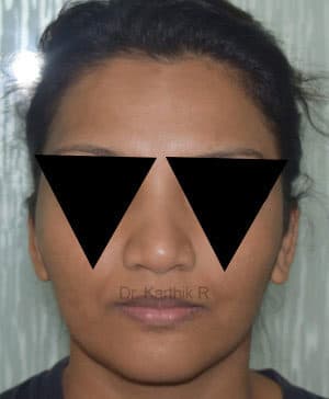 Rhinoplasty (Nose Corrections)